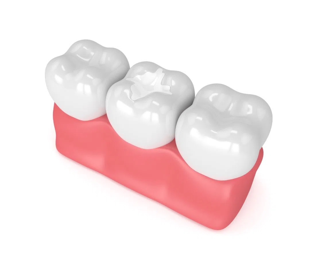 https://lovemysmiledental.ca/wp-content/uploads/2022/09/Composite-fillings.jpg