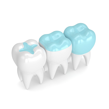 https://lovemysmiledental.ca/wp-content/uploads/2022/09/Inlays-and-Onlays-01.jpg