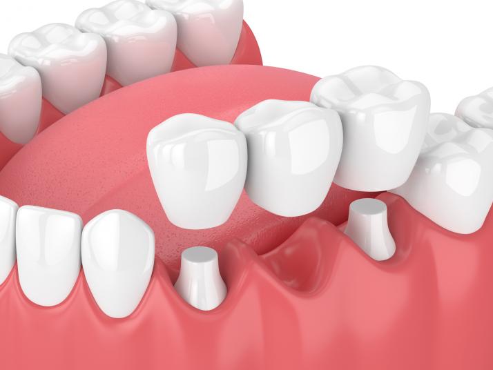 https://lovemysmiledental.ca/wp-content/uploads/2022/09/dental-bridges.jpg