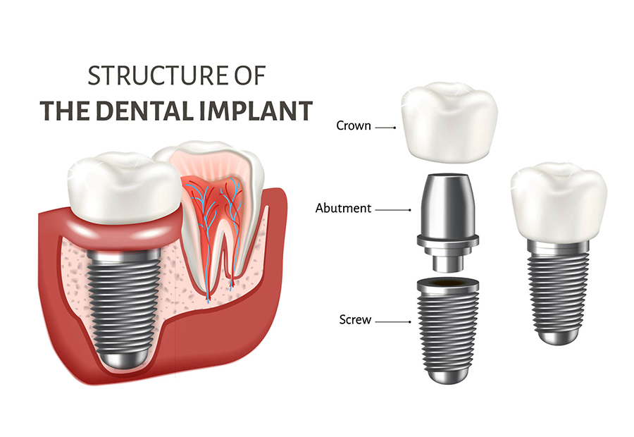 https://lovemysmiledental.ca/wp-content/uploads/2022/09/implant-02.jpg