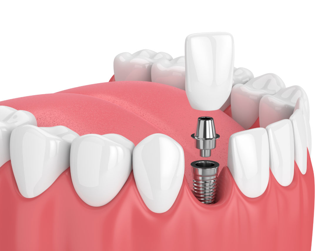 https://lovemysmiledental.ca/wp-content/uploads/2022/09/implants.jpg